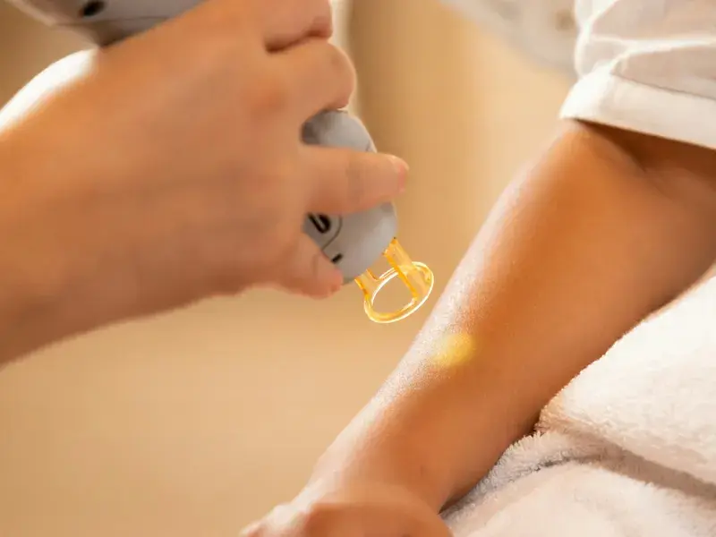Remoción de tatuajes con láser: cuántas sesiones necesitas
